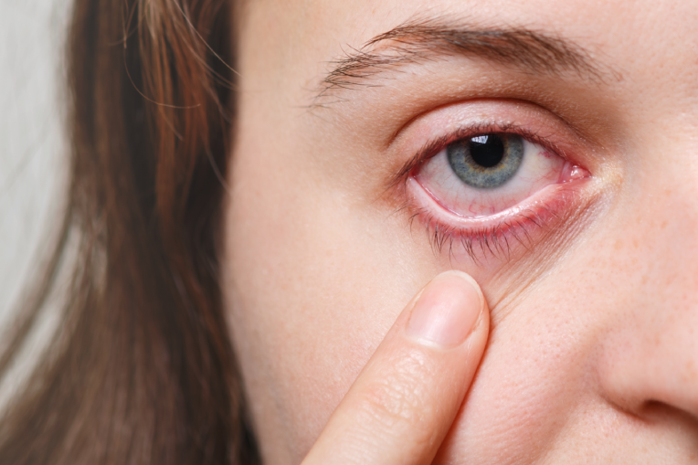 O que você precisa saber sobre o glaucoma?
