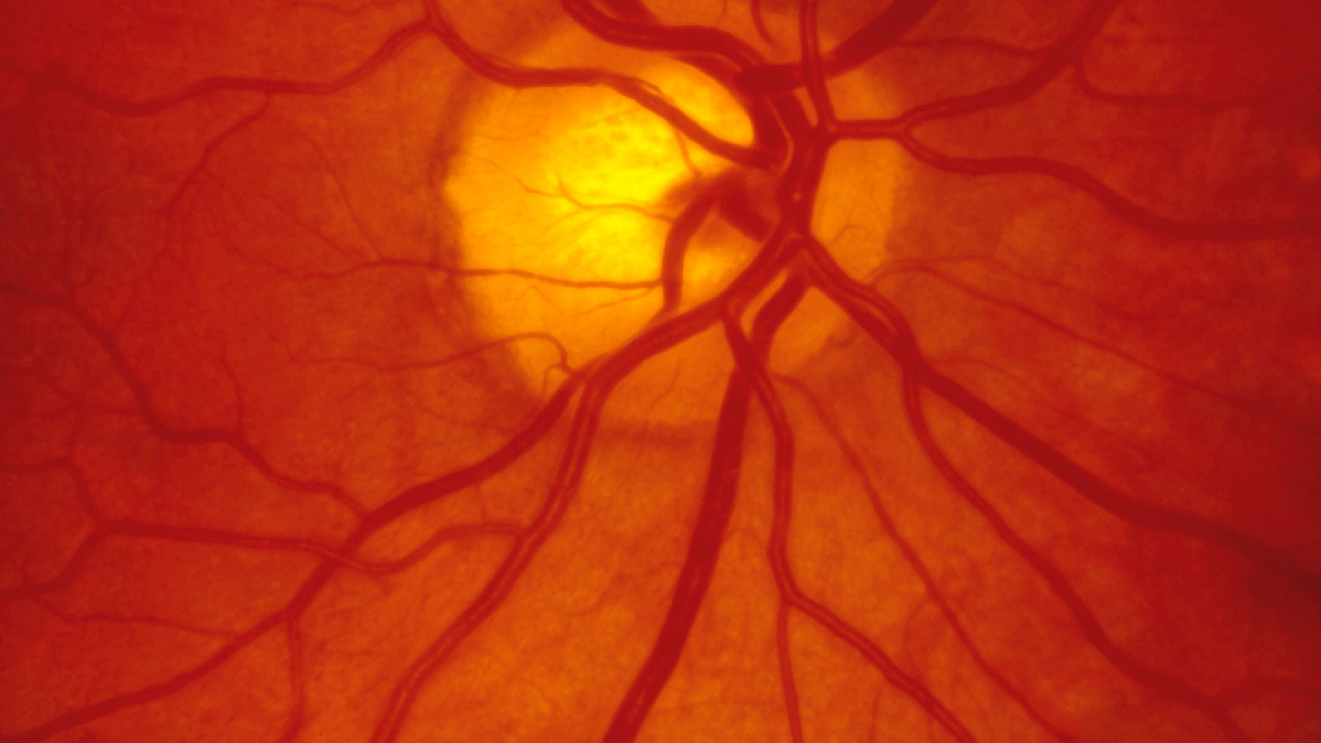 O que é fundo de olho?