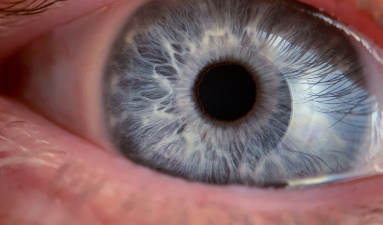 O que é transplante de córnea?