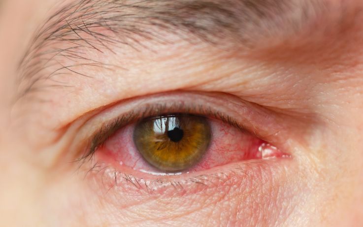 Descolamento de Retina: Sintomas Que Você Não Pode Ignorar 1 descolamento de retina sintomas - Close up de um olho castanho esverdeado com vermelhidao e vasos sanguineos aparentes